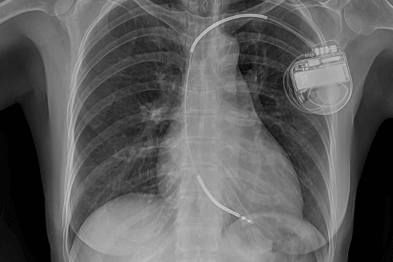 AICD and Combo Device Implantation