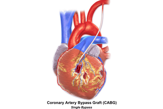 Coronary Artery Bypass Grafting (CABG)