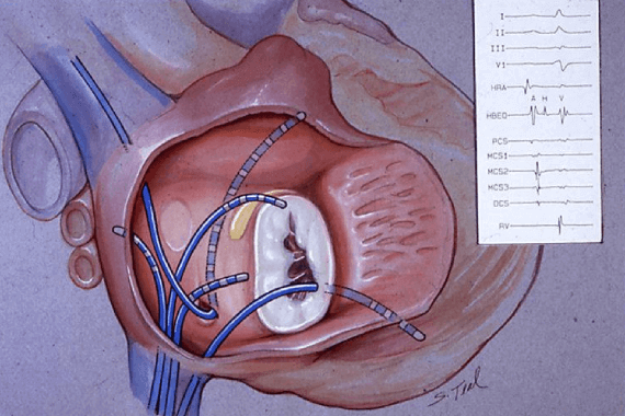 EP Study and Radio Frequency Ablation of Arrhythmias