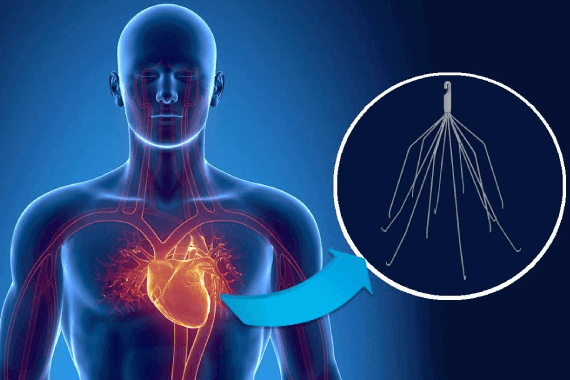 IVC Filter Implantation